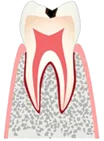 Лечение зубов без сверления краснодар