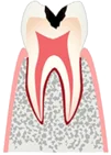 Лечение зубов без сверления в краснодаре thumbnail
